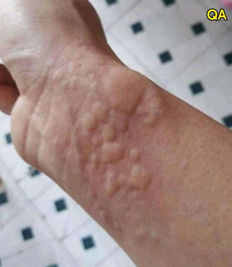 The Hidden Danger on Your Skin: Why Hives and Breathing Changes Are Serious Warning Signs You Should Never Ignore