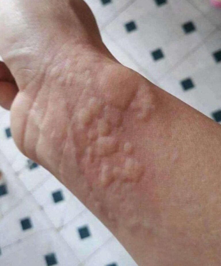 Ignoring Sudden Skin Reactions Can Lead To Very Serious Health Emergencies